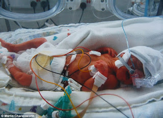 brain injured baby awarded $30 Million settlement in Chicago Illinois