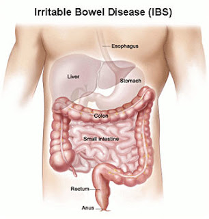  Irritable Bowel Disease, Ericcal koṇṭa kuṭal noy