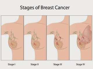  cara elak kanser payudara
