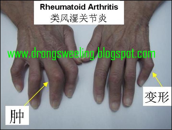 TCM News TCM Doctor Acupuncture for Rheumatoid Arthritis