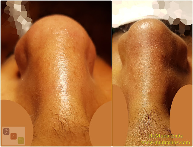 Nasal root filling with subcutaneous tissue - Nasal root filling with underskin tissue - Nose tip plasty - Limited nasal hump removal - Limited nasal hump reduction - Rhinoplasty without breaking the bone - Nose tip plasty in men Istanbul - Nose tip surgery in Istanbul - Nose tip plasty in Turkey