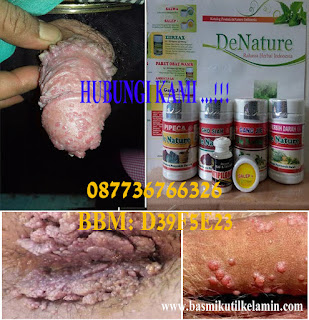 Obat Alami Kutil Kelamin Obat Alami Kutil Kelamin