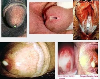 Lubang Penis Nyeri Saat Kencing Dan Keluar Nanah Lubang Penis Nyeri Saat Kencing Dan Keluar Nanah