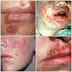 Cara Mengobati Penyakit Herpes Di Mulut Dan Bibir
