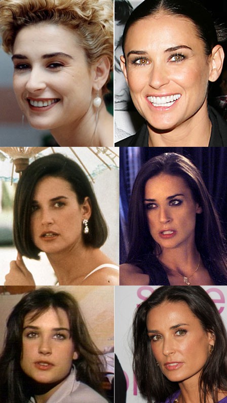 Demi Moore Plastic Surgery Before and After Breast Implants and