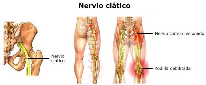 Dolor ciatico derecho biodescodificacion