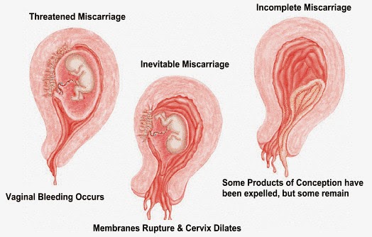 Ways Miscarriage Can Happen