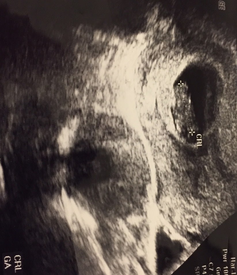 9 Haftalık Gebelik Ultrason Görüntüleri, Anne, Bebek