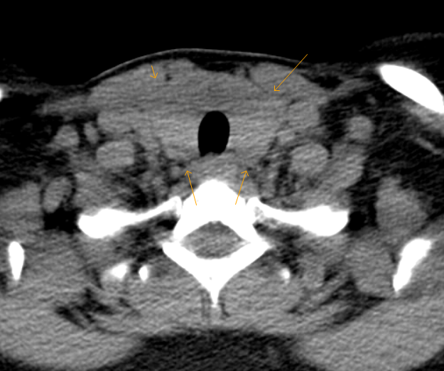 Reduced CT Density Thyroid Gland Sumer's Radiology Blog