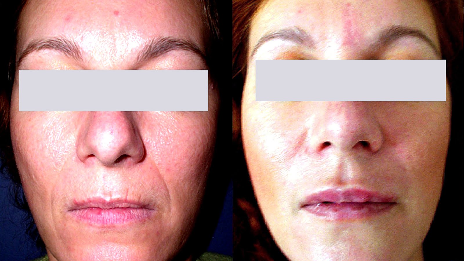 Laser Face Lift Reviews Lift Choices