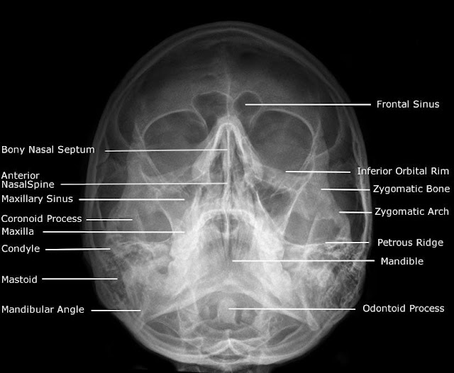 Radiographic Anatomy of Facial Bones and Mandible with Radiological