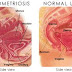 Menu bagi Pesakit ENDOMETRIOSIS