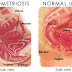 Menu bagi Pesakit ENDOMETRIOSIS