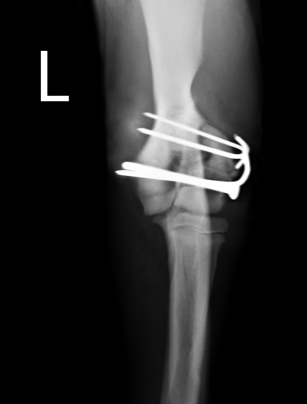 ARTROVET: Fractura del proceso lateral del cóndilo humeral