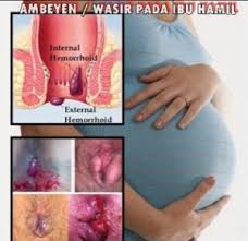 Cara Menyembuhkan Ambeien Pada Ibu Hamil Cara Menyembuhkan Ambeien Pada Ibu Hamil