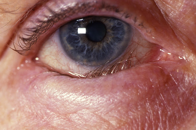 Picture of entropion Lower lid entropion, Trichiasis