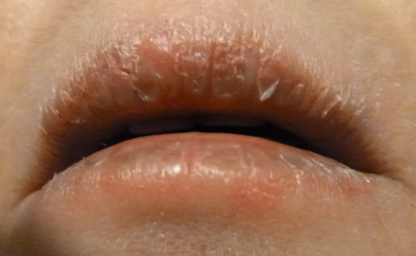 An unknown cause of misery exfoliative cheilitis (chronic peeling