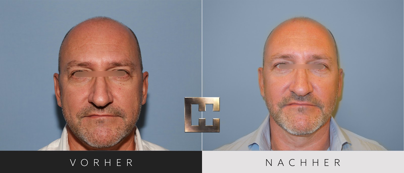 geschlechtsumwandlung genitalien vorher nachher woodenbild )