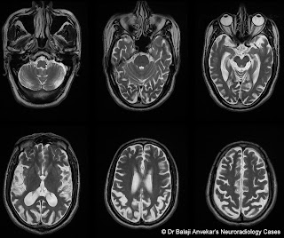Dr Balaji Anvekar FRCR: Posterior cortical atrophy MRI