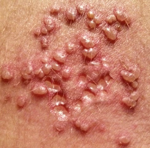 https://4.bp.blogspot.com/-njjRbzL1qzE/WQGw8TOf0OI/AAAAAAAAAdM/vTS2jBKkYlQJeuCgnRnVn8_godVBy6UiwCLcB/s1600/bintik%2Bherpes.jpg