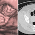 Beware: The Real Truth About Colonoscopy Nobody Talks About