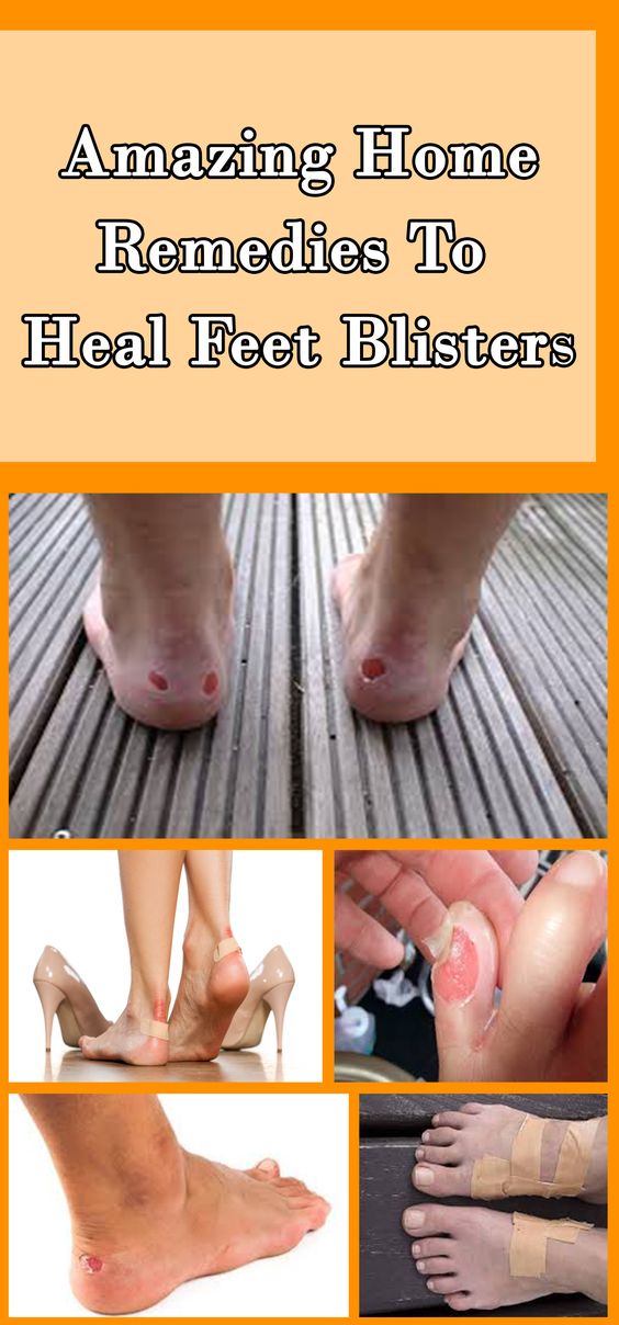 Home Remedies For Feet Blisters !!! HEALTH RECIPES