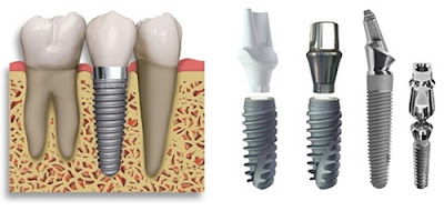 Dịch vụ trồng răng Implant thẩm mỹ