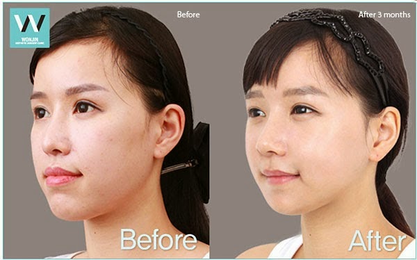 Челюстно лицевая операция до и после Lip Protrusion