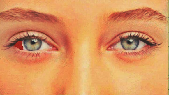 How to Quickly Treat Red Eyes Disease How to Quickly Treat Red Eyes Disease