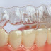 Tẩy trắng răng bằng máng có mang lại hiệu quả cao?