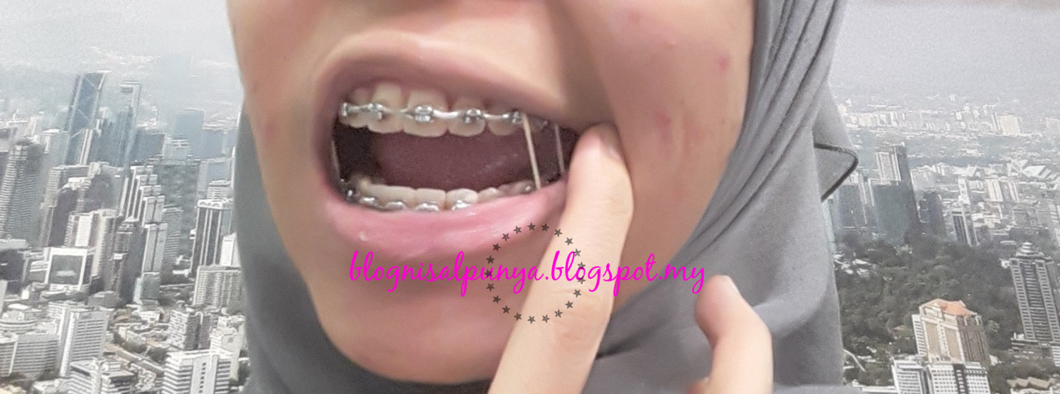 Blog Sal Braces Journey Part 8 Cabut braces!!!
