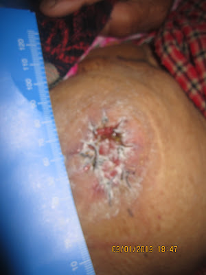 stoma colostomy bag ostomy skin apply uneven care powder applying peristomal depressed january