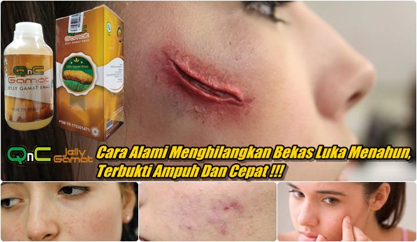 Cara Menghilangkan Bekas Luka Menahun, Terbukti Ampuh Dan Cepat Cara Menghilangkan Bekas Luka Menahun