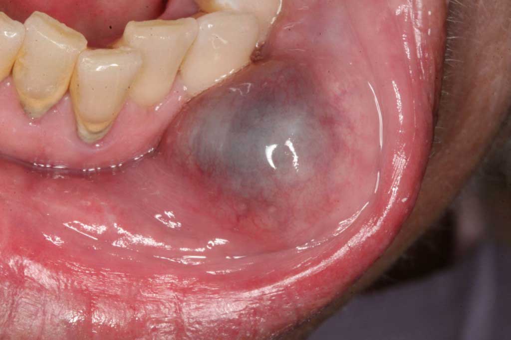 cirugia buco maxilo facial Nasty dildo insertions