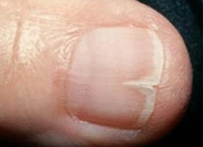 vertical cracks in big toenail? | Yahoo Answers