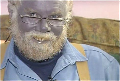 colloidial silver blue skin colloidial silver blue skin