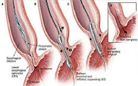 Penyakit Akalasia, Gangguan Pada Kerongkongan Penyakit Akalasia, Gangguan Pada Kerongkongan