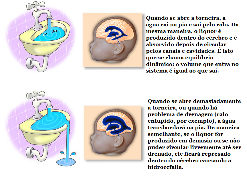 Ana Lucia Hennemann Neuropsicopedagoga Clínica Hidrocefalia