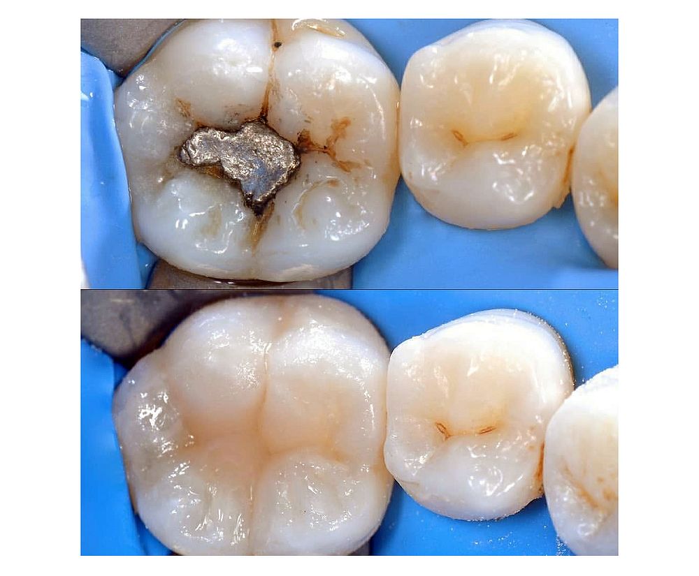 ESTÉTICA DENTAL Beneficios del cambio de amalgamas por resinas Directorio Odontológico ESTÉTICA DENTAL Beneficios del cambio de amalgamas por resinas Directorio Odontológico