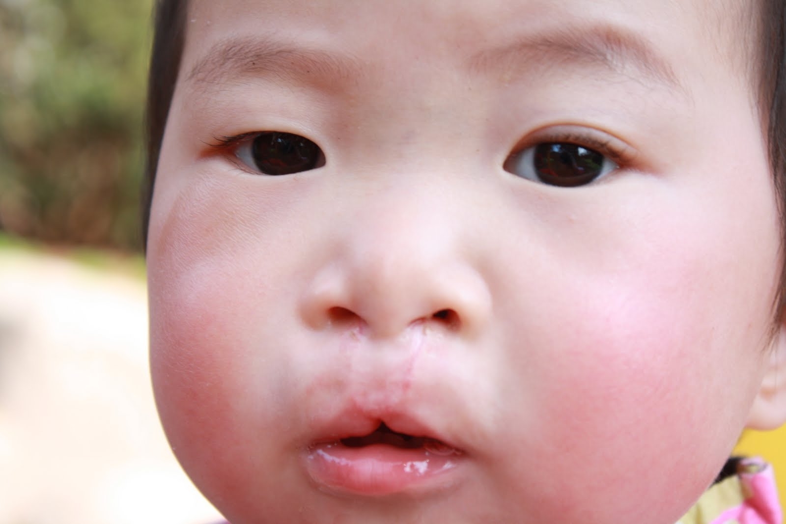 By Grace We Are Six cleft palate repair an update