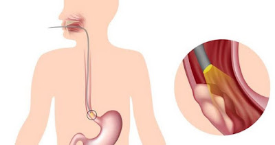 https://www.gastrosurgeoncochin.com/oesophagus-cancer.html