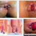 Obat Wasir Bengkak Ampuh Ambeclear thumbnail