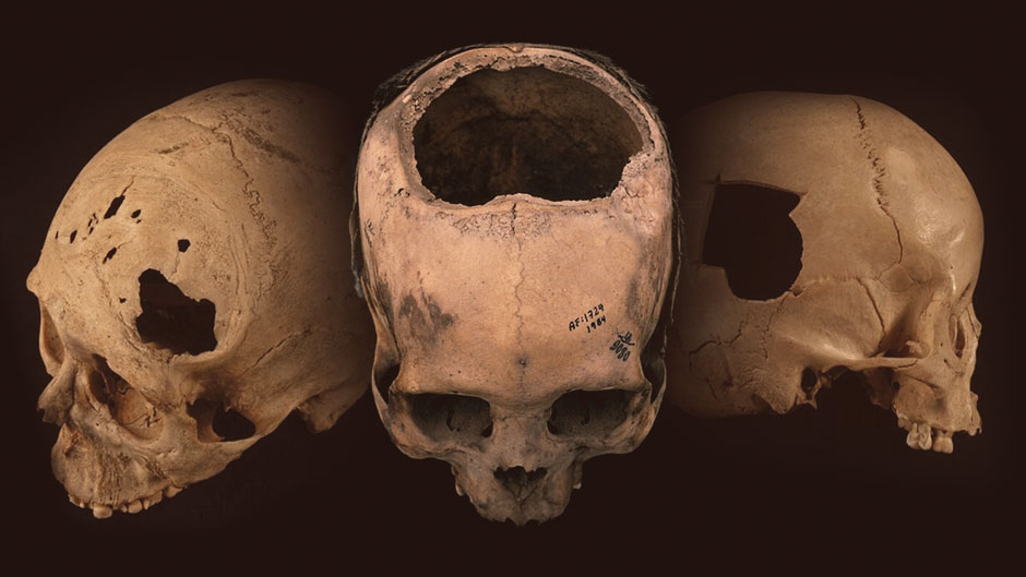 Cráneos antiguos trepanados procedentes de Perú. Foto: University of Miami. Cráneos antiguos trepanados procedentes de Perú. Foto: University of Miami.