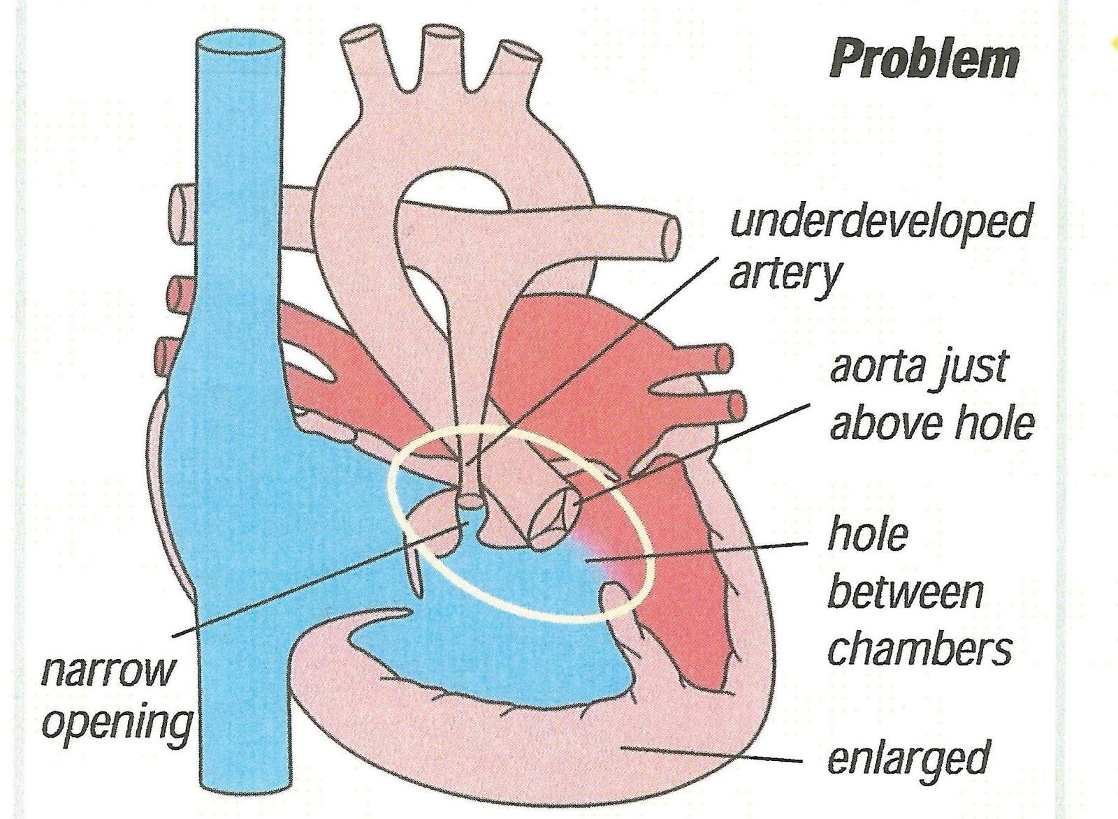 Matters of the Heart What is Tetralogy of Fallot?