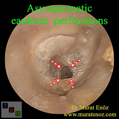 Asymptomatic eardrum  perforations - small eardrum hole