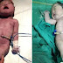 The Heartbreaking Story Of The 'Mermaid Baby' That Shocked The World