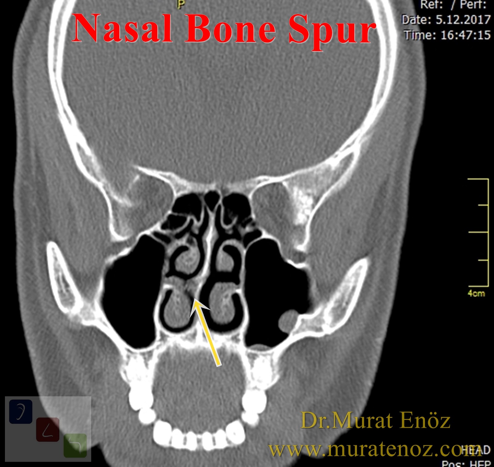 Health Zone Turkey Nasal Bone Spur Symptoms, Diagnosis, Treatment