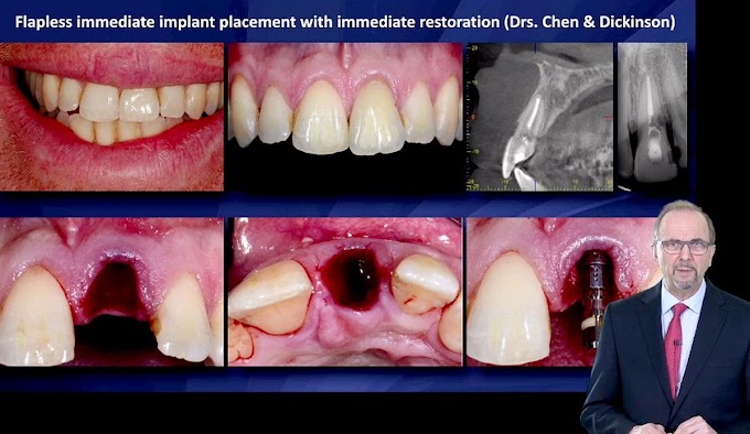 IMPLANTOLOGY: Implant Placement Post-Extraction in Esthetic Single Tooth Sites 