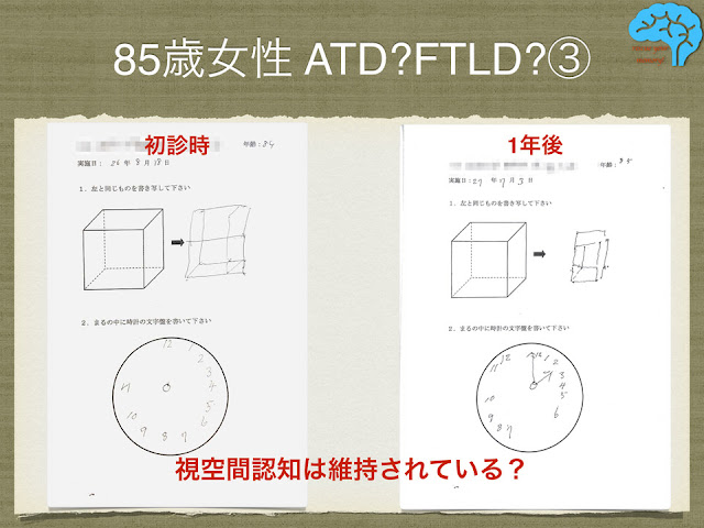 視空間認知の悪化はないようだ