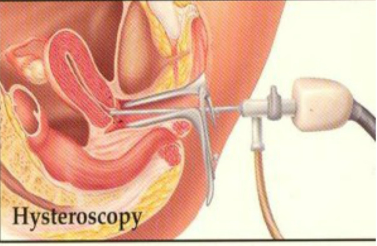Гистероскопия раздельное выскабливание. Эндометриоз матки гистероскопия. Полип эндометрия гистероскопия. РДВ шейки матки гистероскопия. Вакуумное выскабливание полости матки.